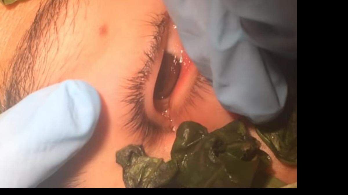 La larva fue extraída en una operación realizada el miércoles mediante el uso de medicina tradicional sin necesidad de practicar un corte cercano al ojo izquierdo del paciente.