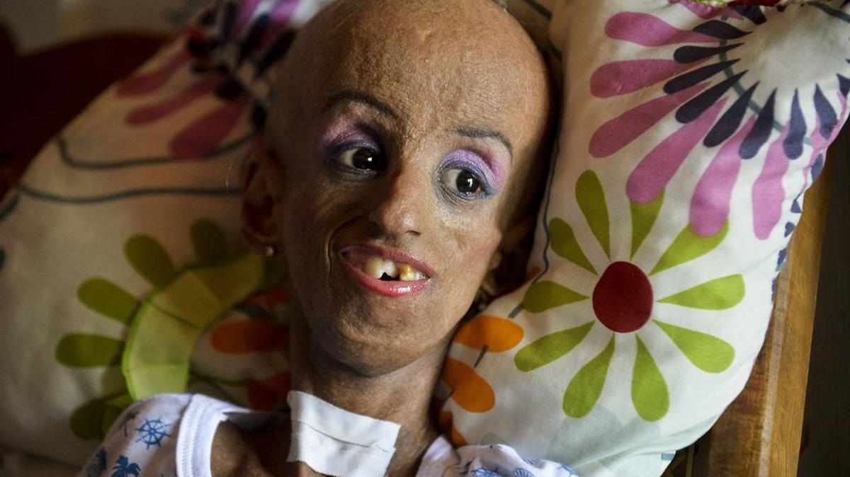Magali González Sierra, una niña con progeria, celebró este fin de semana en zona rural del municipio de Candelaria, oeste de Colombia, sus 15 años, aunque su cuerpo refleje 90. Toda una hazaña: quienes padecen la rara enfermedad suelen morir en la adolescencia.