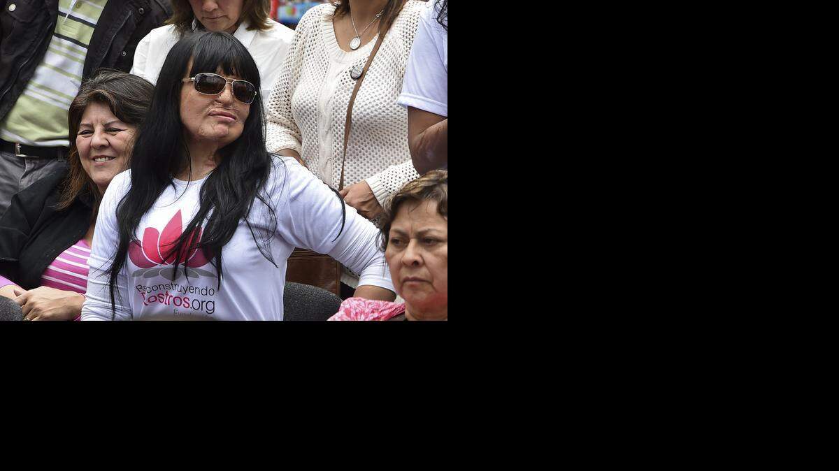 
Nubia Patricia Espitia, de 33 años, sufrió quemaduras en su rostro en el 2008 por un ataque con ácido en Colombia.
