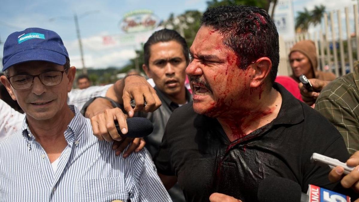 Augusto Valle, diputado del opositor Partido Liberal Independiente (PLI), habla con periodistas en noviembre, en Managua, tras ser herido durante una manifestación para exigir elecciones libres en el 2016.