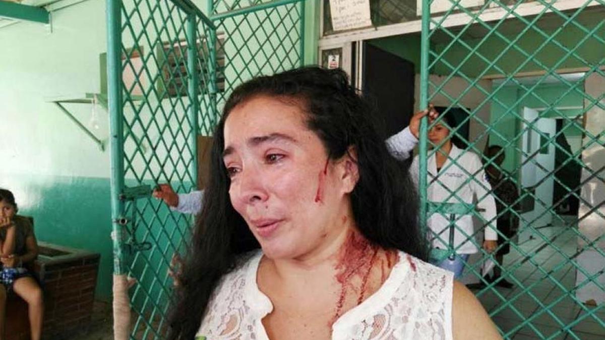 La activista de la oposición en Nicaragua, Gabriela García, sufrió heridas en la cabeza.