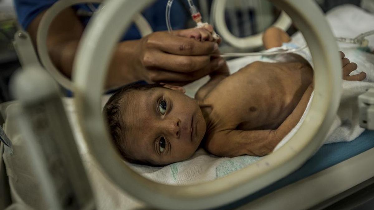 A los 18 días de nacido Esteban Granadillo fue llevado el 28 de agosto al Hospital Universitario de Pediatría Agustín Zubillaga, en Barquisimeto, Venezuela, por desnutrición. El niño falleció el 8 de octubre.