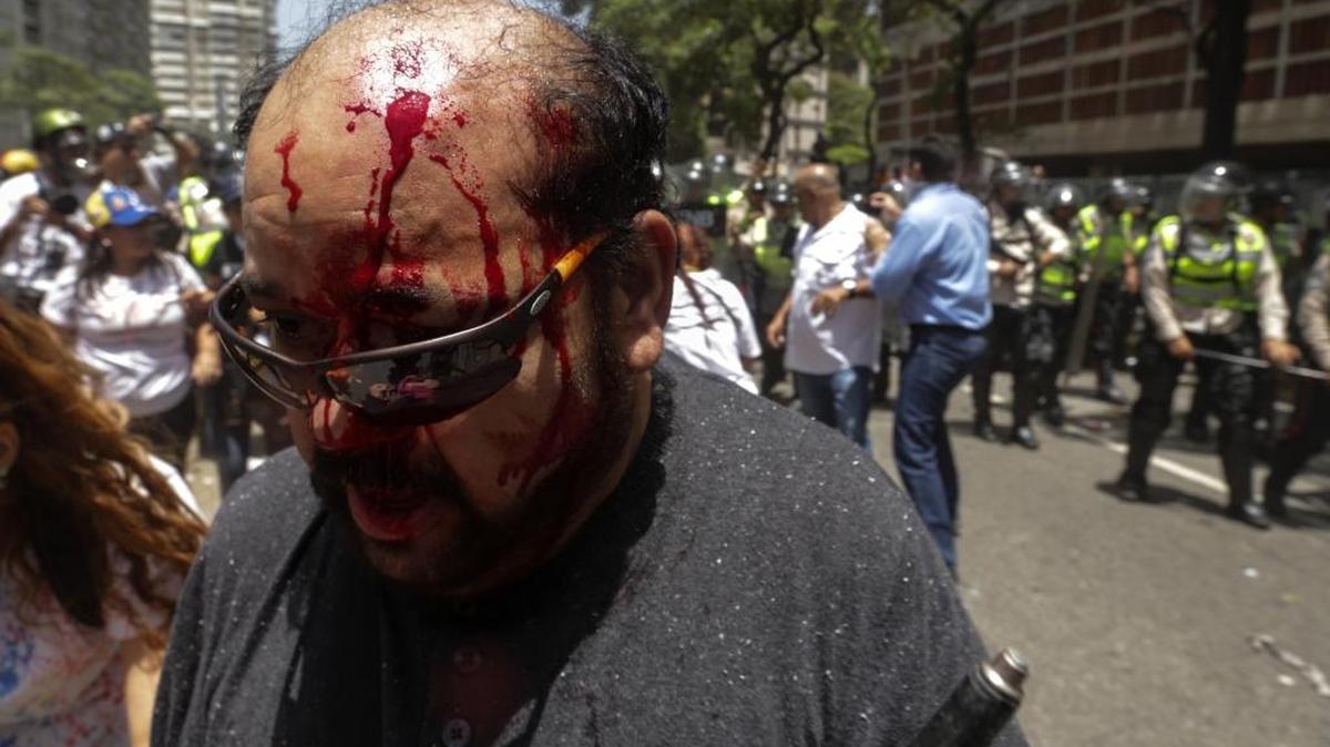 Un hombre sale herido durante una manifestación disuelta por miembros de la Policía Nacional Bolivariana el martes 4 de abril de 2017, que intentaba marchar hacia el Parlamento en apoyo a la destitución de los magistrados del Supremo, en Caracas (Venezuela). La Guardia Nacional Bolivariana de Venezuela (GNB, policía militar) disolvió con gases lacrimógenos y perdigones de goma una manifestación de decenas de opositores.