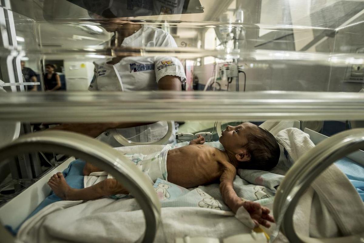 A los 18 días de nacido Esteban Granadillo fue llevado el 28 de agosto al Hospital Universitario de Pediatría Agustín Zubillaga, en Barquisimeto, Venezuela, por desnutrición. El niño falleció el 8 de octubre.