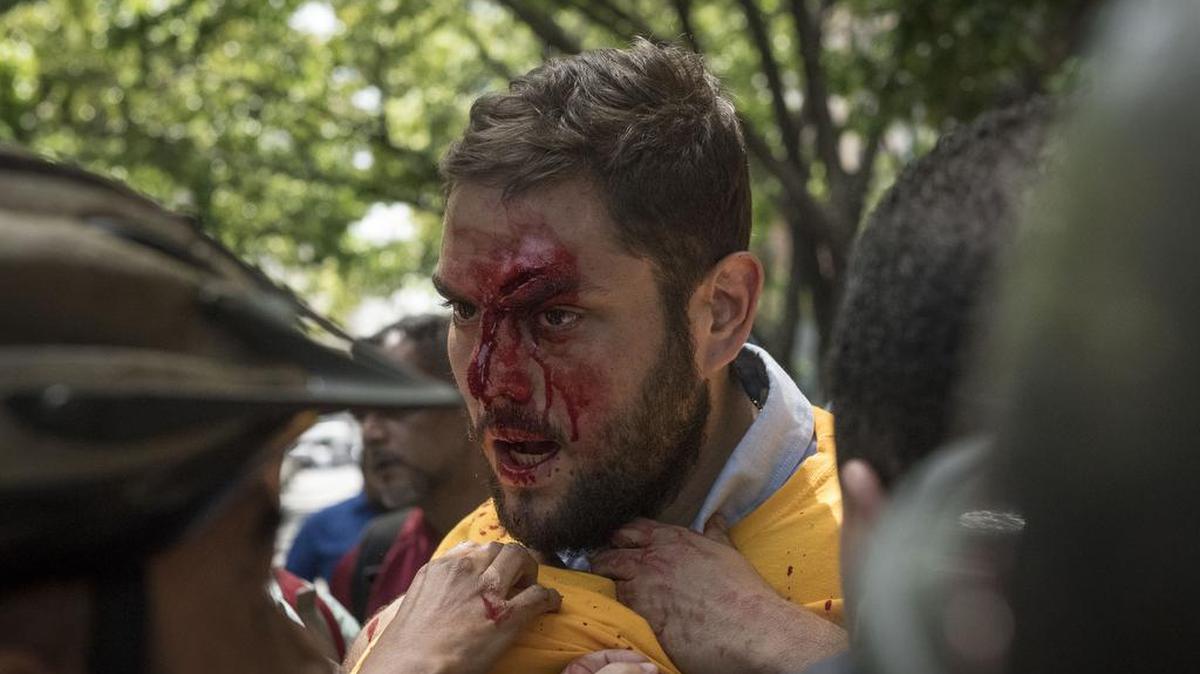 El diputado del partido opositor Primero Justicia, Juan Requesens, resultó herido en la cabeza por presuntas personas armadas durante una manifestación el lunes 3 de abril de 2017, en Caracas (Venezuela).