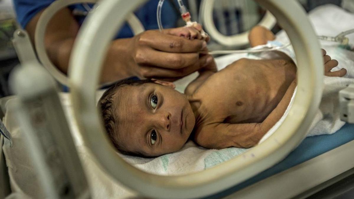 Esteban Granadillo, de 18 días, pesa 4 libras y 10 onzas en el Hospital Universitario de Pediatría Dr. Agustín Zubillaga en Barquisimeto, Venezuela, 28 de agosto de 2017.