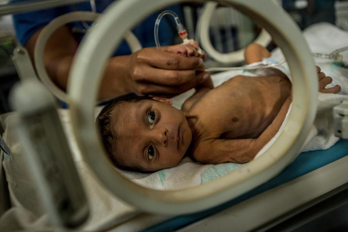 A los 18 días de nacido, Esteban Granadillo fue llevado al Hospital Universitario de Pediatría Dr. Agustín Zubillaga, en Barquisimeto, por desnutrición.