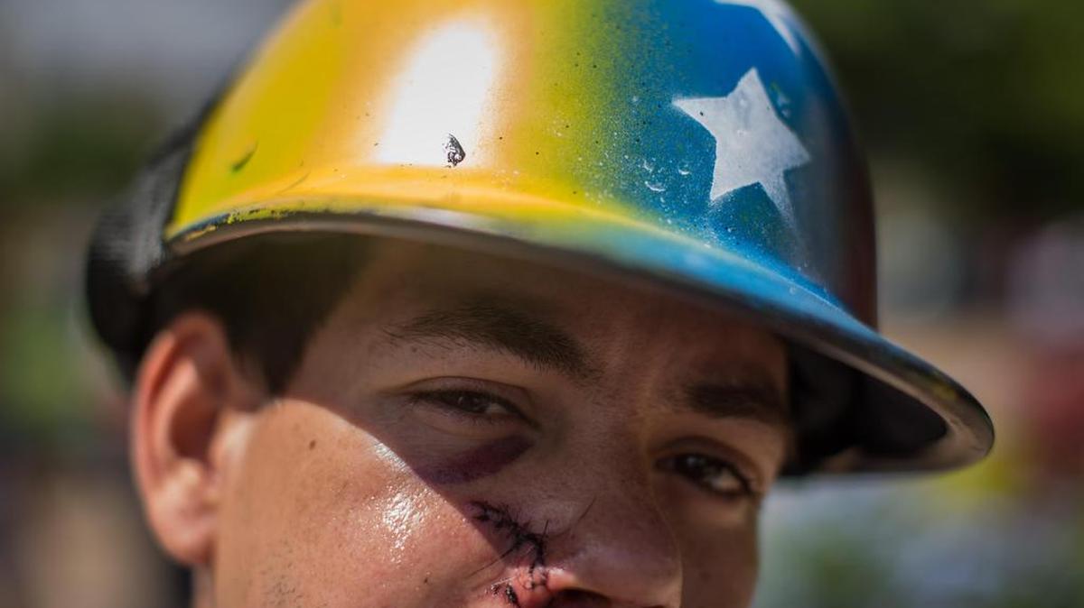 Un joven muestra la herida ocasionada por el impacto de una bomba lacrimógena el sábado 20 de mayo de 2017, en Caracas (Venezuela).