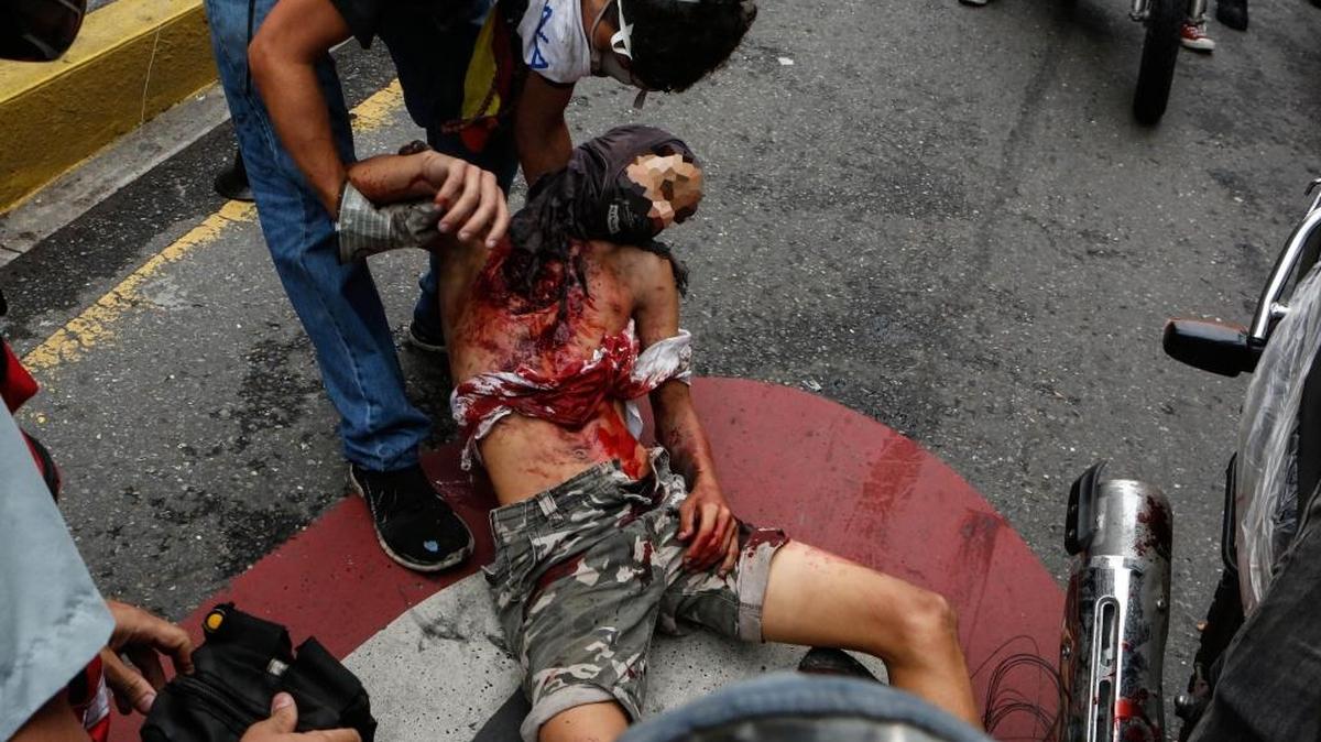 Vista de un manifestante herido el miércoles 7 de junio de 2017, en Caracas. La protesta antigubernamental que se llevó a cabo el miércoles en Caracas terminó con varias personas lesionadas, entre ellas un joven que sufrió una herida abierta en el pecho.
