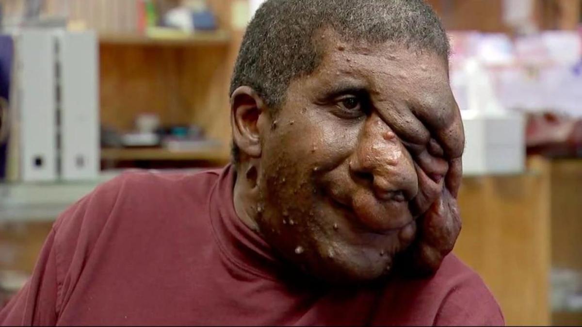 Reggie Bibbs, de 52 años, sufre de una enfermedad que le ha causado el crecimiento de tumores en el rostro.