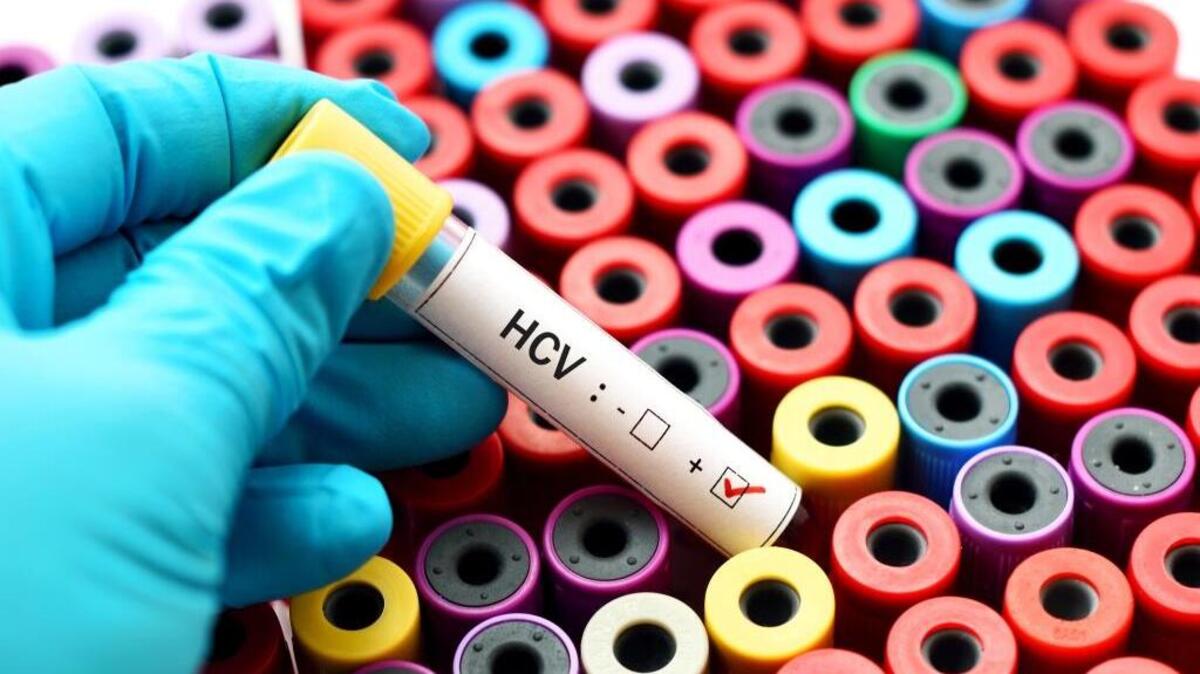 Una prueba da positivo a la presencia de hepatitis C.