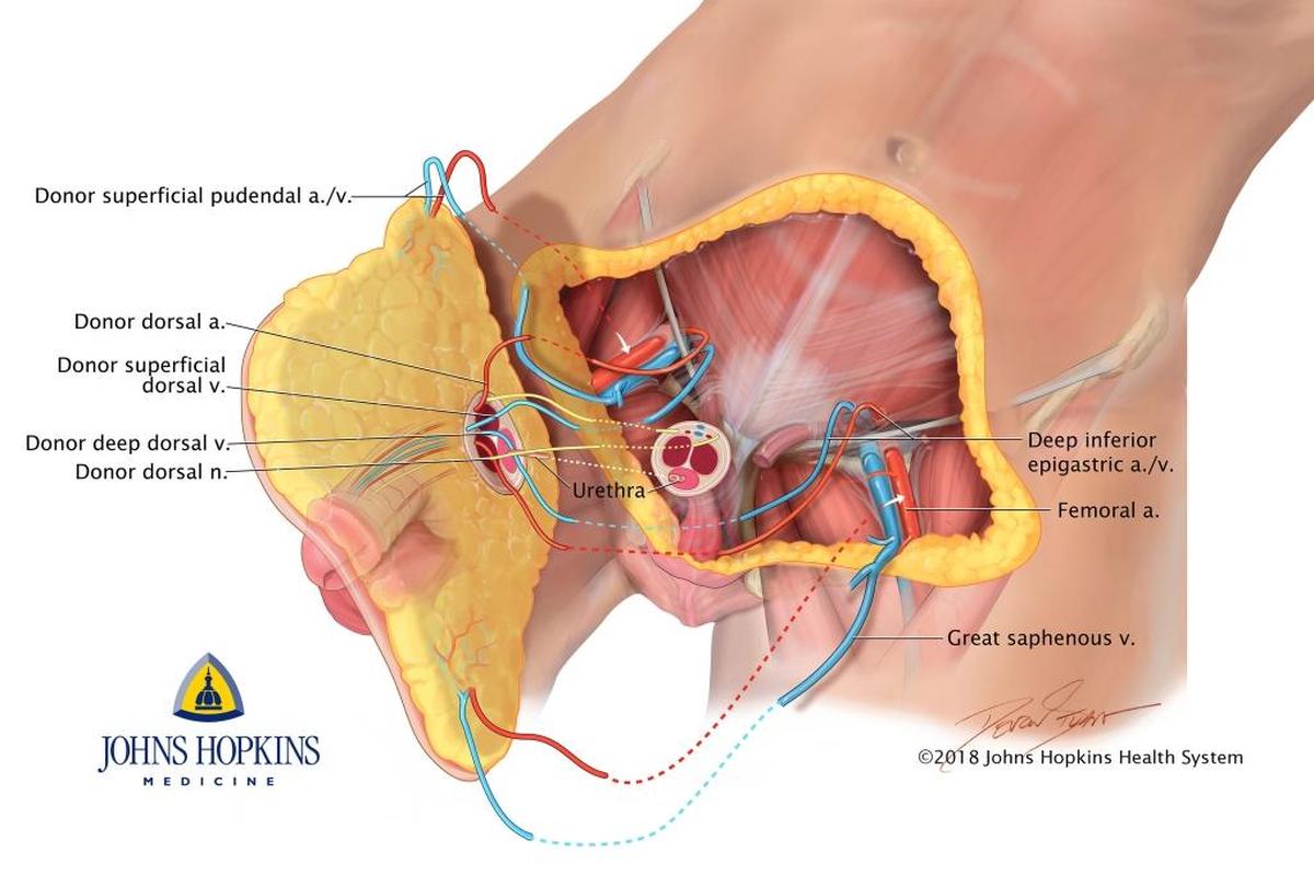 Fotografía cedida que muestra un dibujo del primer trasplante de pene y escroto realizado por la Facultad de Medicina de la Universidad Johns Hopkins con sede en Baltimore (Maryland).