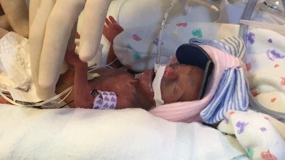 Lailie Victoria, una bebé de casi cuatro meses y medio que pesó al nacer solo 13 onzas (poco más de 368 gramos), recibió el viernes 29 de diciembre de 2017 el alta Baptist Children's Hospital de Miami con un peso de 5,1 libras (2,3 kilos). La "niña milagro", como la han apodado los medios de comunicación, fue entregada por los médicos del a sus padres, Jaksiri y Marcos Ruiz-Toledo.