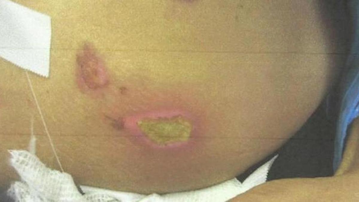 Estas son algunas de las quemaduras que habrían sido causadas por el derramamiento de un café caliente sobre la colombiana Belia Peña García en un vuelo de Republic Airlines, propiedad de American Airlines.