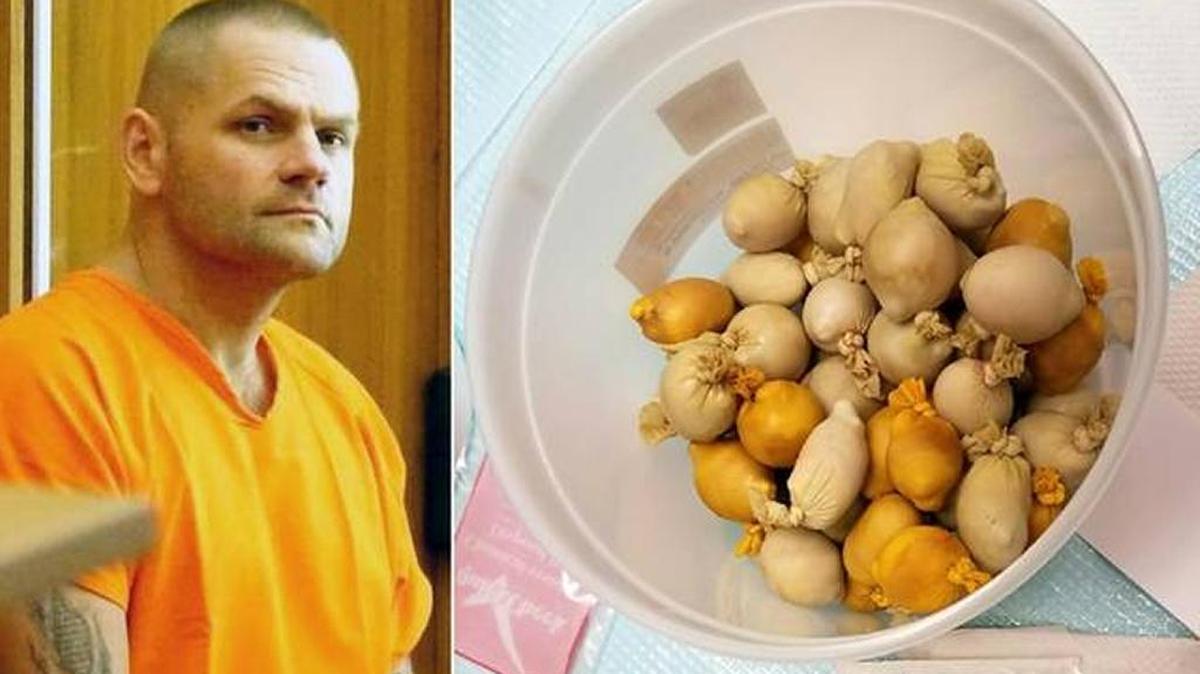Los cirujanos encontraron 53 pequeñas bolsas de goma dentro del estómago de Waldemar Wojtczak, de Polonia