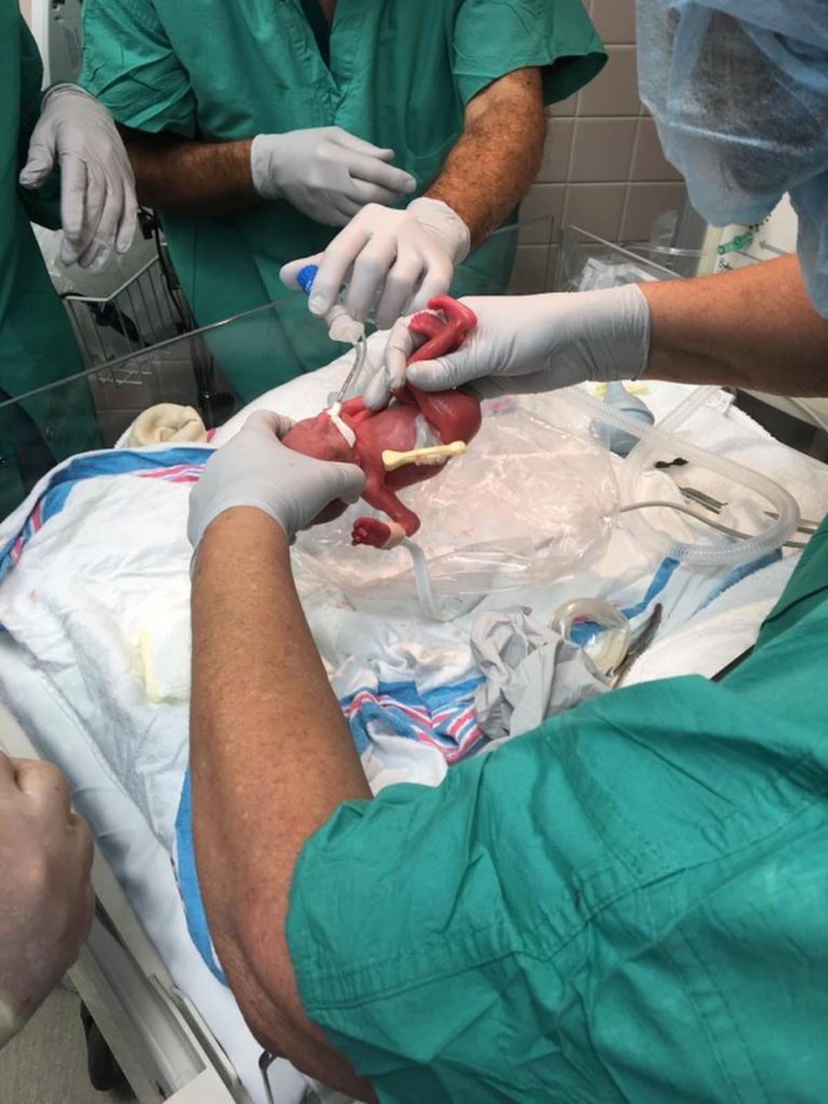 Lailie Victoria, una bebé de casi cuatro meses y medio que pesó al nacer solo 13 onzas (poco más de 368 gramos), quien recibió el 29 de diciembre de 2017 el alta del Baptist Children's Hospital con un peso de 5,1 libras (2,3 kilos).