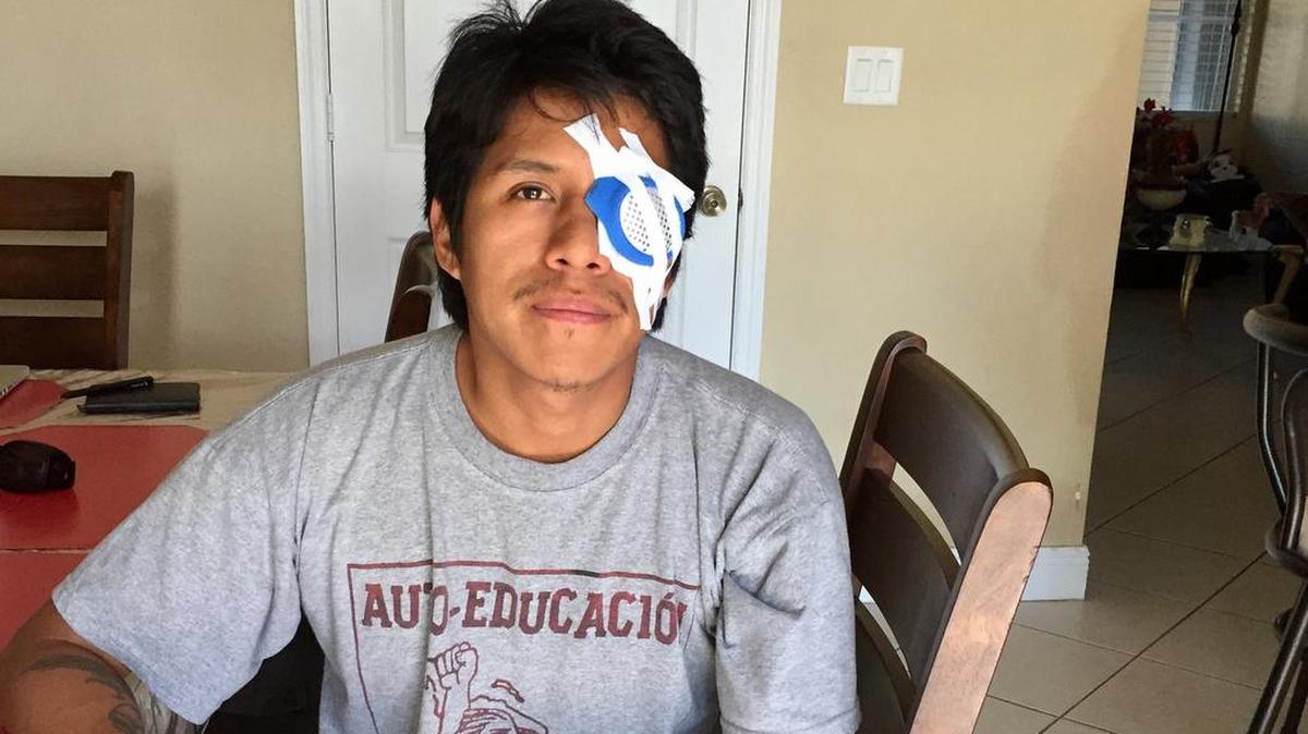 El fotorreportero Marcos Ramón, del rotativo Perú21, llegó a Miami para ser sometido a cirugías oftalmológicas de alto riesgo, tras ser baleado con perdigones en el ojo izquierdo durante una manifestación en Lima.