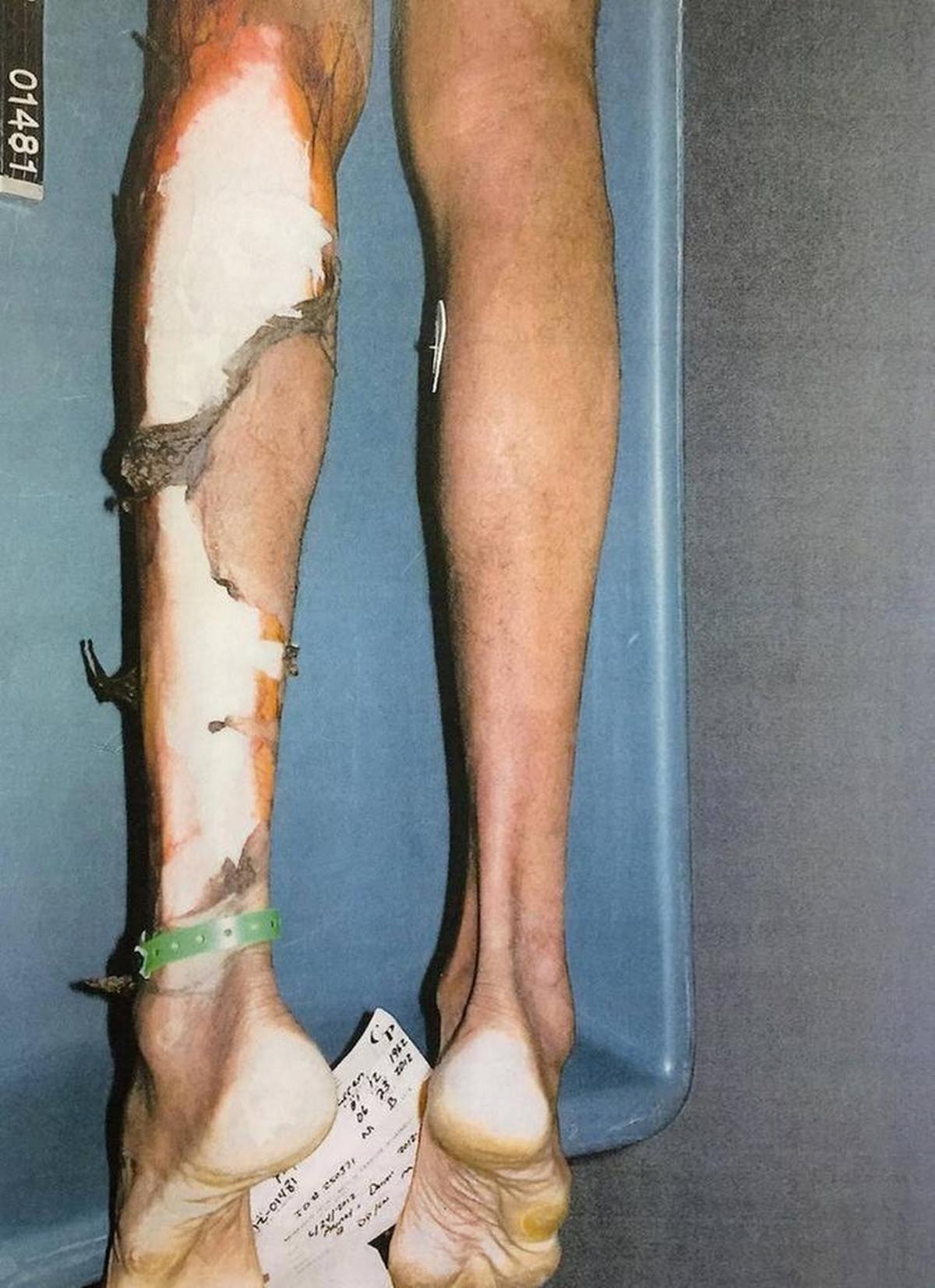 El agua hirviendo de la ducha en la unidad de salud mental de la prisión Dade Correctional Institution provocó fuertes quemadas a Darren Rainey después que colapsó en el lugar.