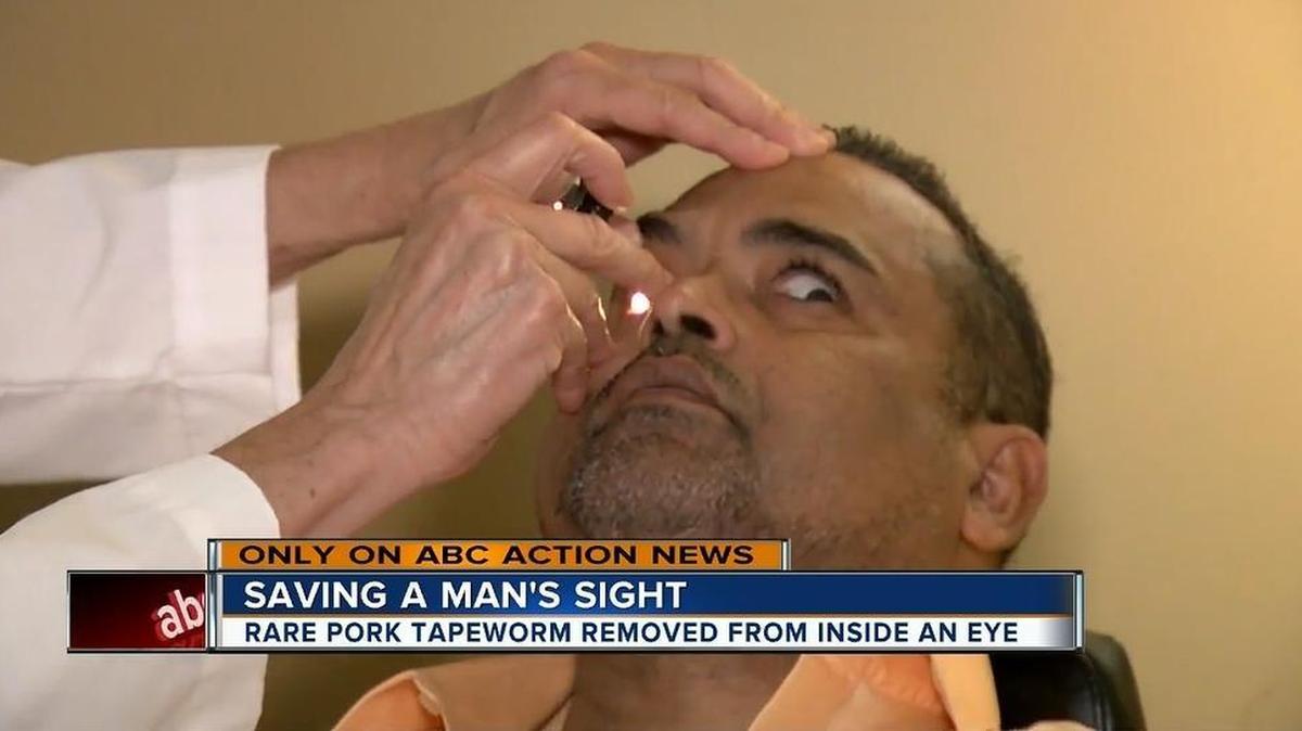 El Dr. Don Pérez examina a Sam Cordero en el Hospital General de Tampa, en un fotograma de un video de la televisora WFTS. Cordero tenía el gusano alojado en el ojo izquierdo; se piensa que quizás lo ingirió al comer carde de cerdo medio cruda durante la Navidad.