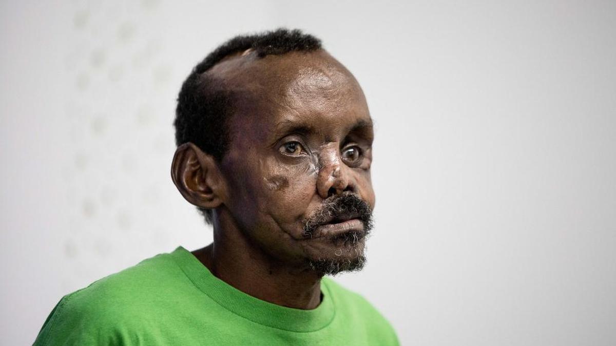 El pastor keniata Lonunuku, de 58 años, tras la reconstrucción parcial del rostro y la mano izquierda tras ser atacado por una hiena.