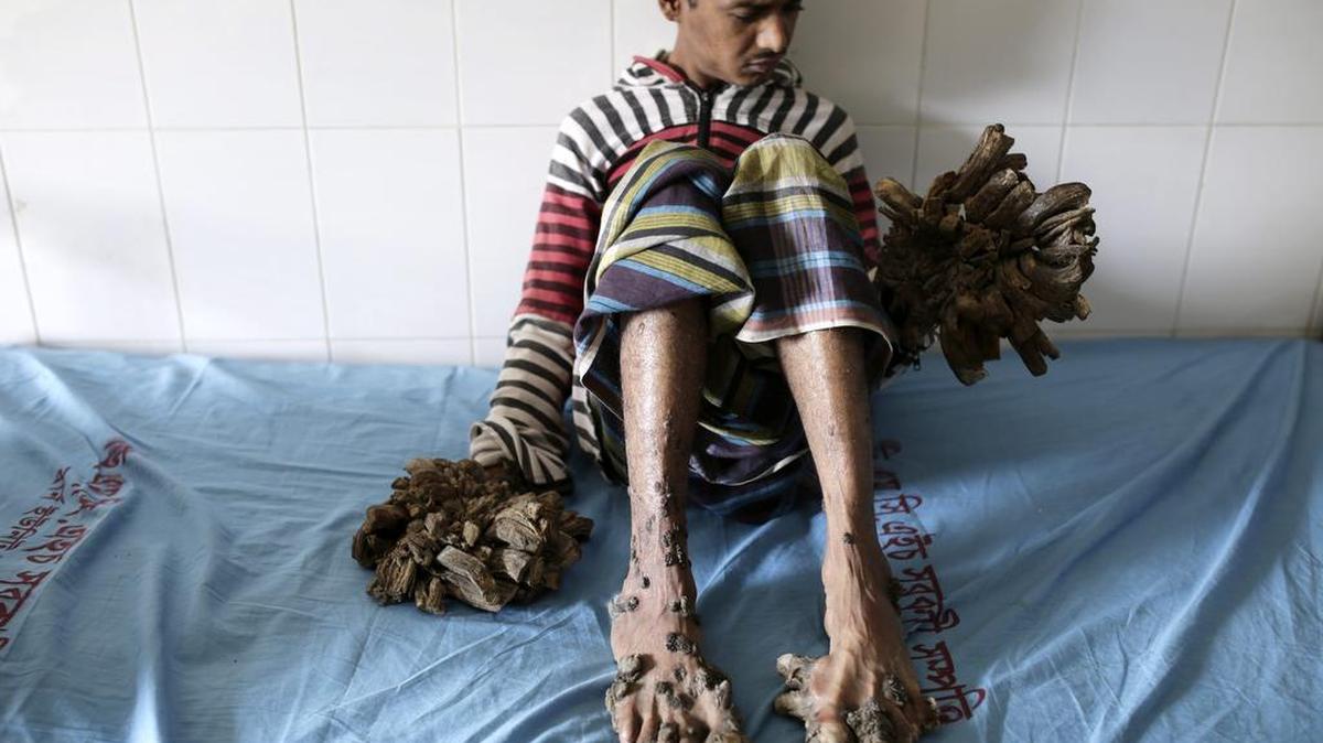 Abul Bajandar, un paciente diagnosticado con epidermodisplasia verruciforme, recibe atención médica en Dacca (Bangladesh). Abul sufre de esta enfermedad desde los 4 años.