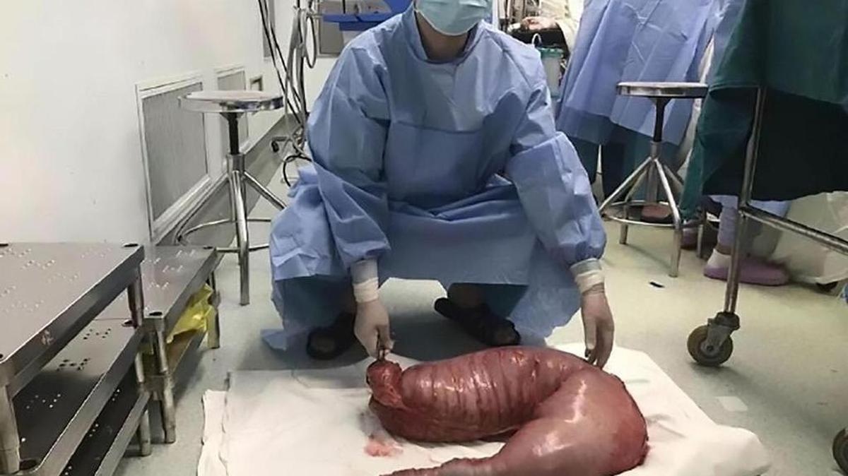 A un joven de 22 años le extrajeron el colon, que medía 76 cm de largo y tenía 13 kilos de materia fecal.