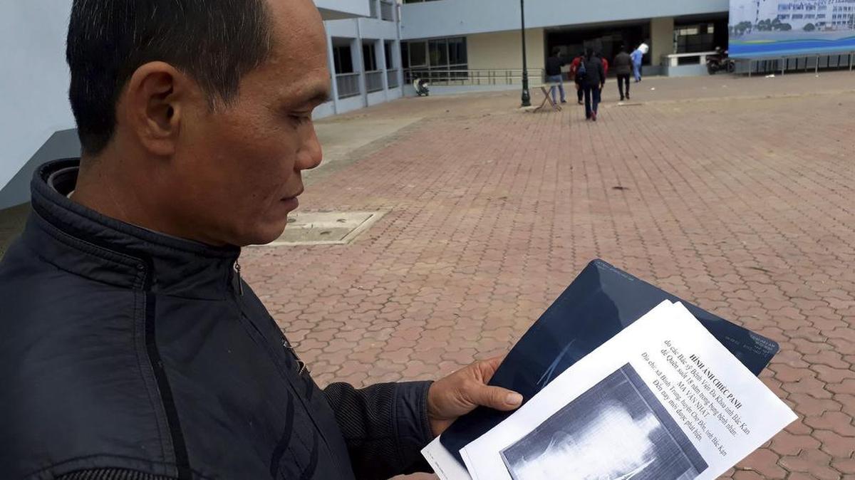 Fotografía facilitada el 3 de enero de 2017 de Ma Van Nhat, un hombre de 54 años, en la que muestra una radiografía de su abdomen en la que aparecen unas tijeras de 15cm rotas en la provincia de Thai Nguyen (Vietnam).