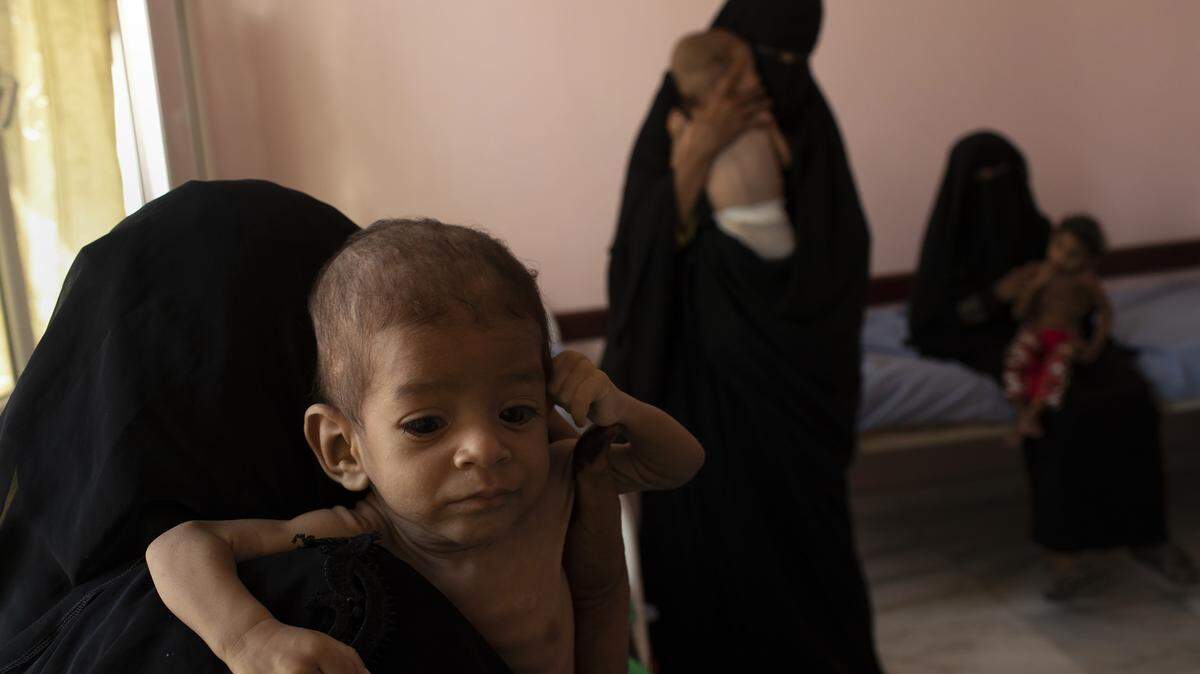 El hambre está afectando a los niños de Yemen, un país que está pasando por una guerra civil.