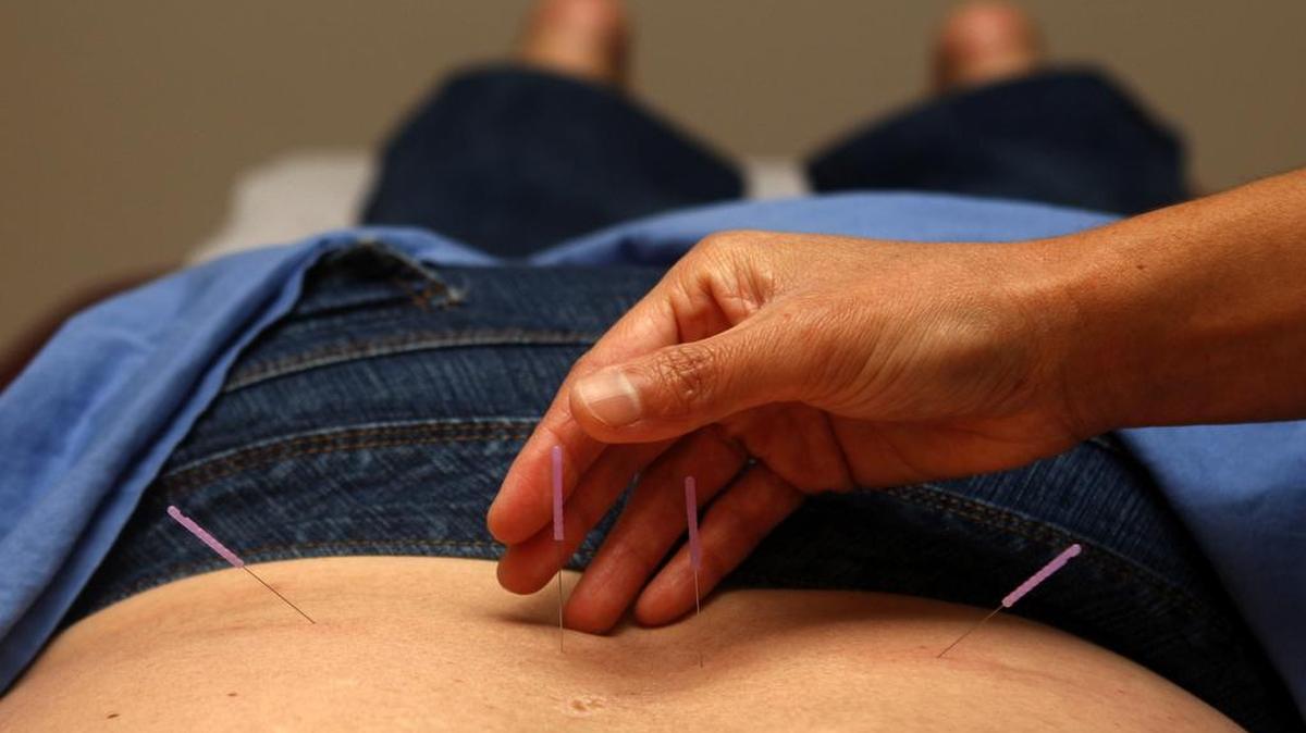 La acupuntura es una forma de medicina alternativa que ha ganado popularidad.