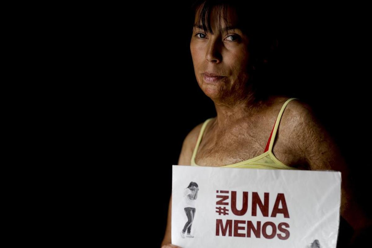Maira Maidana sufre quemaduras porque su esposo le prendió fuego y cerró todas las llaves de agua de la casa. Ella encontró el coraje para denunciarlo.