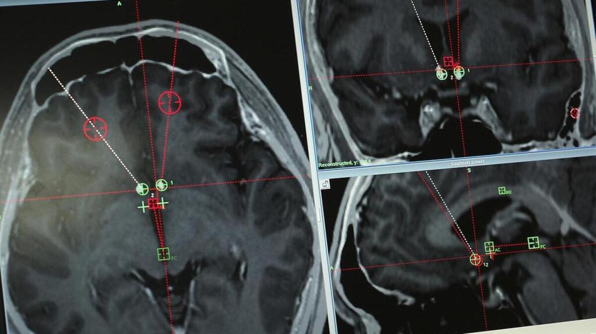 Un scan del cerebro de un usuario de metamfetamina con los electrodos implantados.