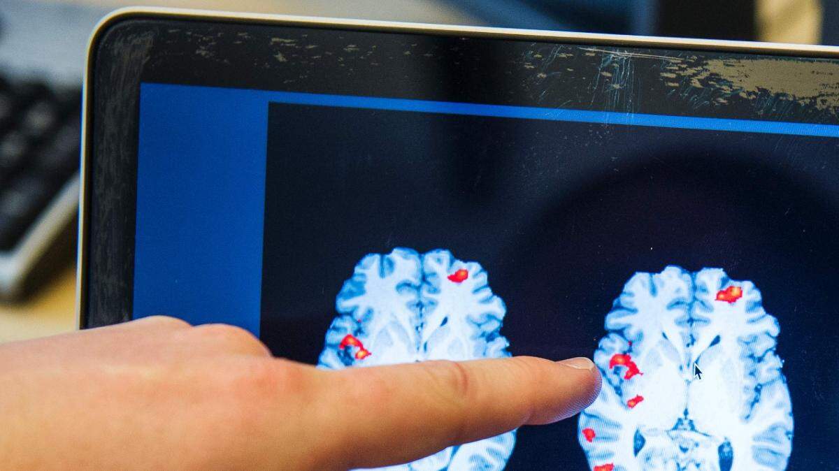Archivo. Foto de un escaneo cerebral en el hospital Huddinge en Estocolmo. 