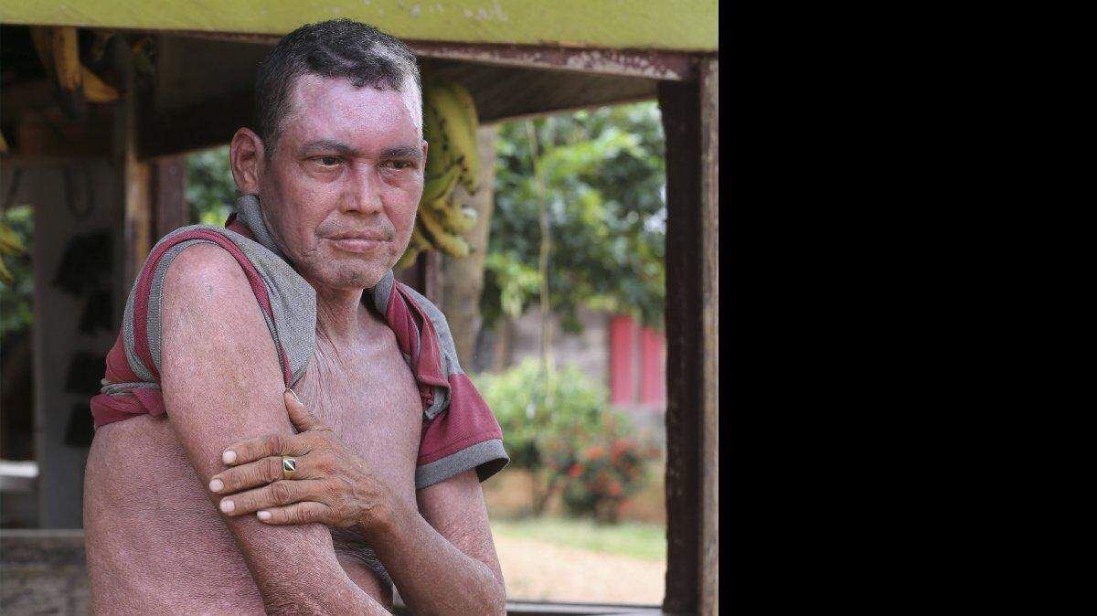 En esta foto del lunes 11 de mayo 2015, Manuel de Jesús Sánchez muestra su cuerpo durante una entrevista con The Associated Press en el estado noroccidental de Córdoba en Colombia. Sánchez afirma que hace cuatro años estaba trabajando en su campo de arroz cuando fue rociado con productos químicos desde un avión, y desde entonces ha sufrido problemas de la piel y visión disminuida. Los cuentos de los efectos nocivos para la salud abundan en la región donde los cultivos de coca proliferan y se fumigan con glifosato por parte de la campaña de erradicación respaldada por Estados Unidos. El presidente Juan Manuel Santos pidió un alto en la fumigación en la estela de un informe de la Organización Mundial de la Salud clasificando la sustancia glifosato cancerígena.