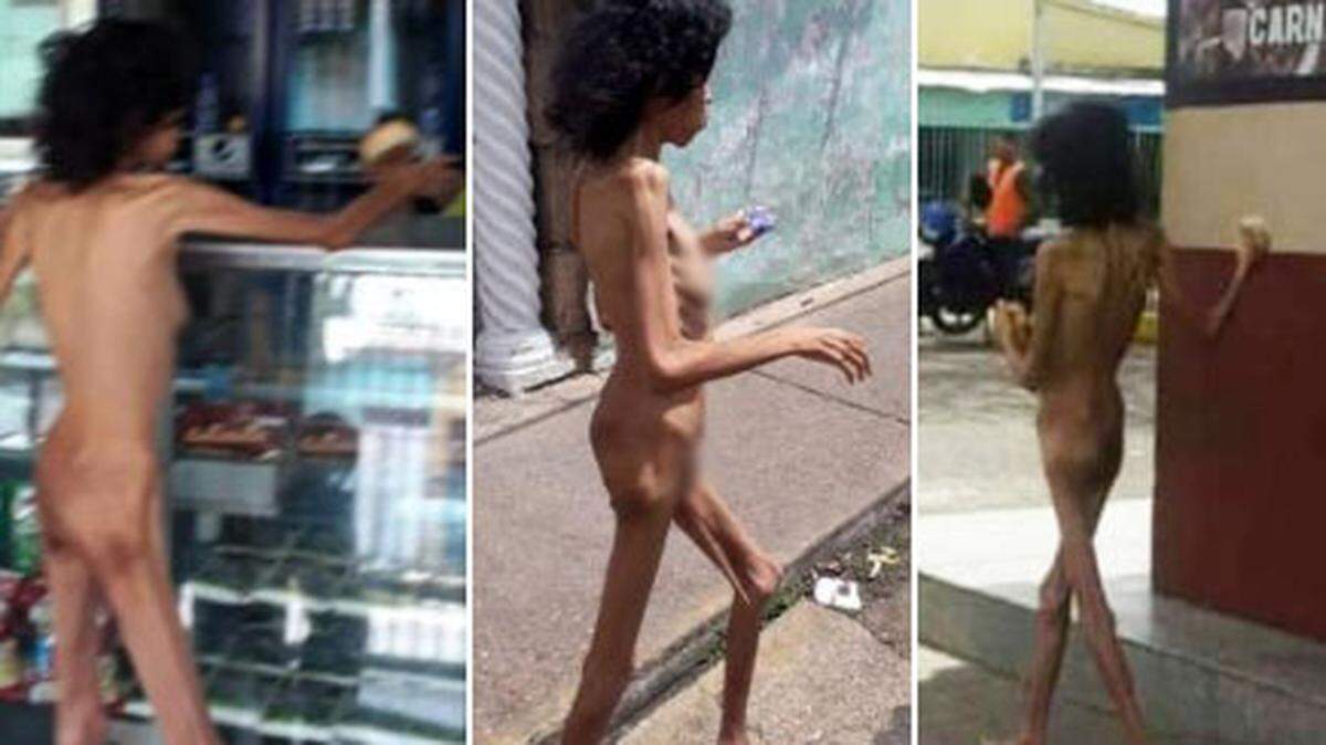 Una mujer de Cantaura, capital del municipio Freites, en Anzoátegui, decidió mostrar los estragos del hambre en su cuerpo para pedir comida.