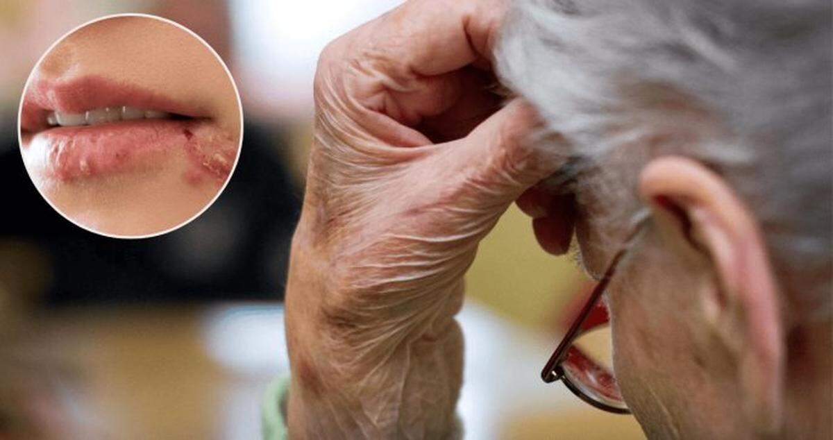 El patógeno que causa el herpes es capaz de infectar también las neuronas que inervan esa misma zona de la piel.