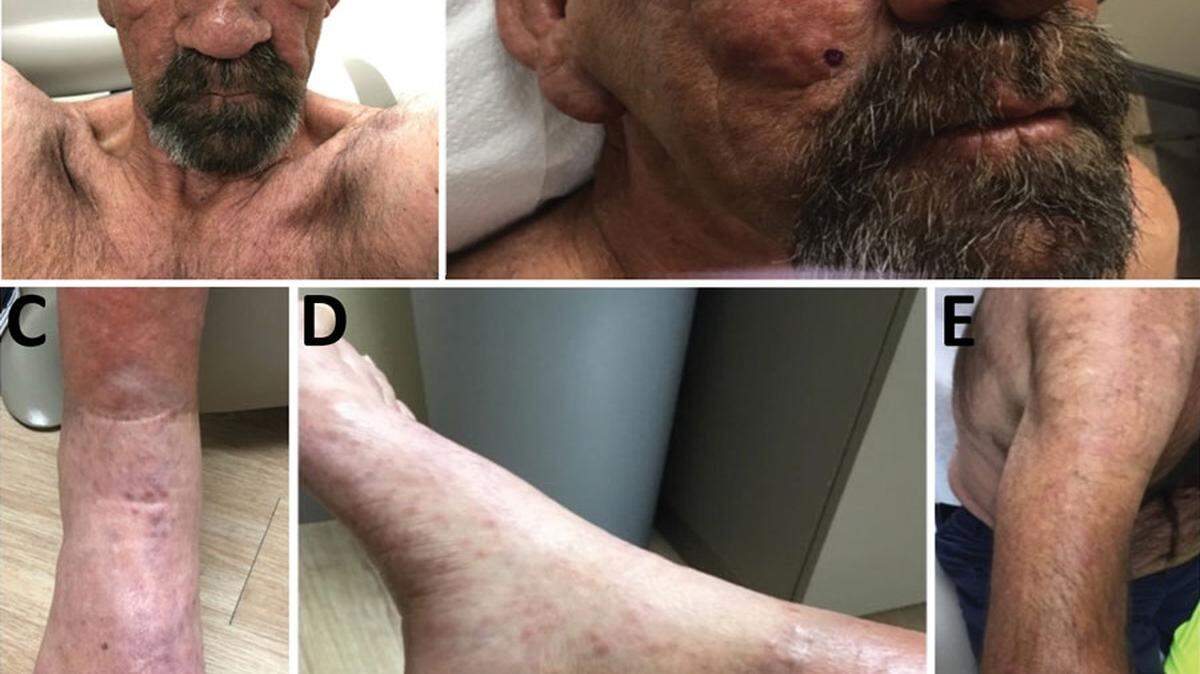 Lepra lepromatosa en un hombre de 54 años en el centro de Florida, caso registrado en 2022.