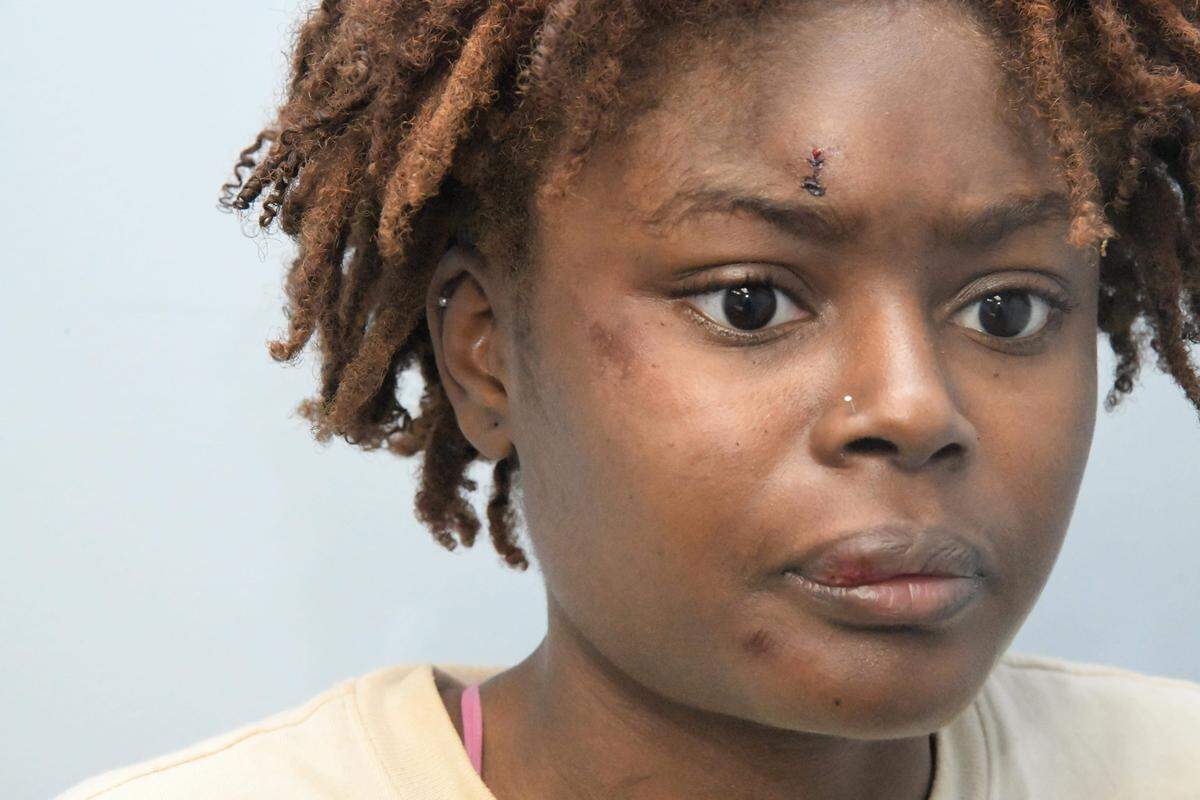 Lesiones de Esther Sanon tras el encuentro del 10 de abril de 2023 que terminó de forma violenta.