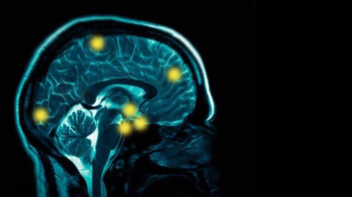 La amígdala, una parte del cerebro asociada a las emociones, presentaba un mayor nivel de actividad cuando los participantes contaban por primera vez una de esas mentiras. AP-Archivo