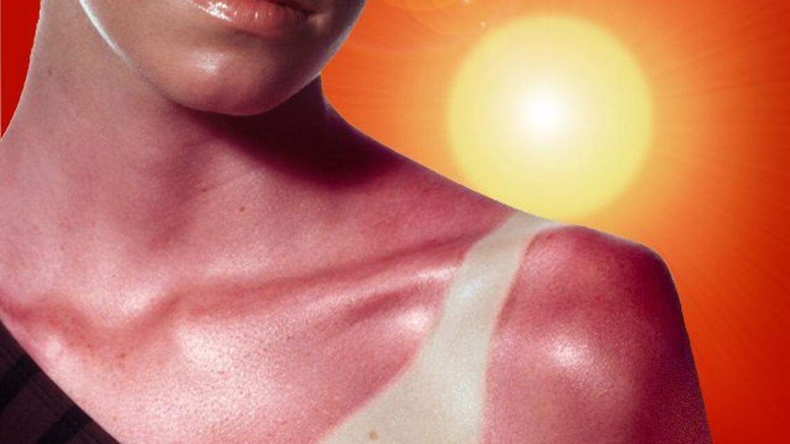 The more sunburns you have, the higher your risk for melanoma. Follow these four tips to cut your risk of sunburns.