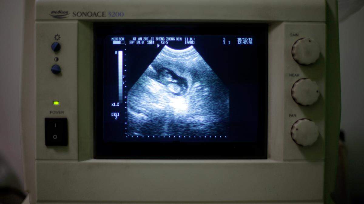 Los investigadores generalmente usan tejido fetal a partir de abortos electivos en lugar de abortos involuntarios porque los abortos espontáneos suelen ser el resultado de anomalías cromosómicas u otros problemas del desarrollo que podrían hacer que el tejido no sea adecuado para la investigación.