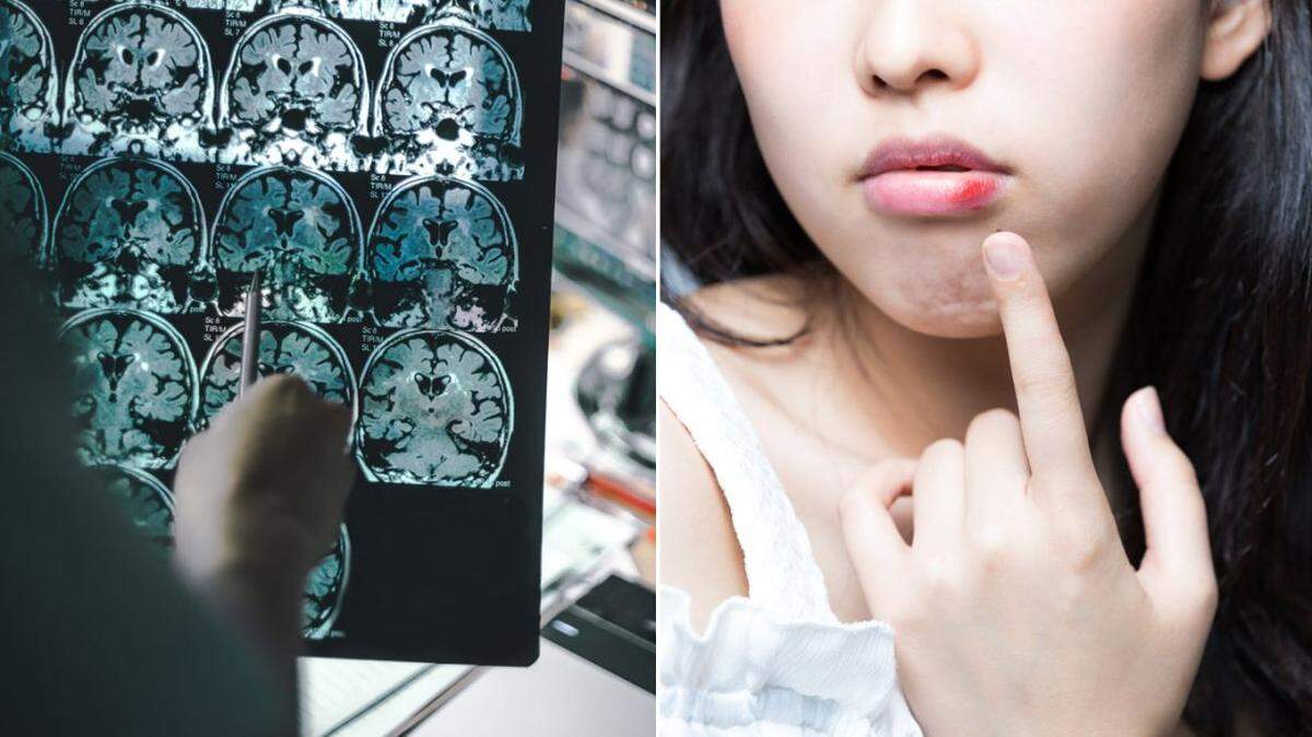 Una vez que una persona ha contraído una infección por herpes, el virus permanece en el organismo durante toda la vida.