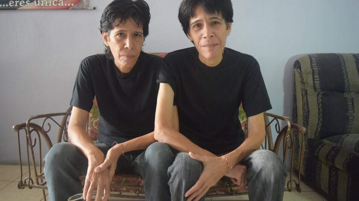 Lamski y Tatsienlu Pérez, en Valencia, Venezuela, dicen que han perdido 77 libras cada una desde el colapso de la economía en el 2015.