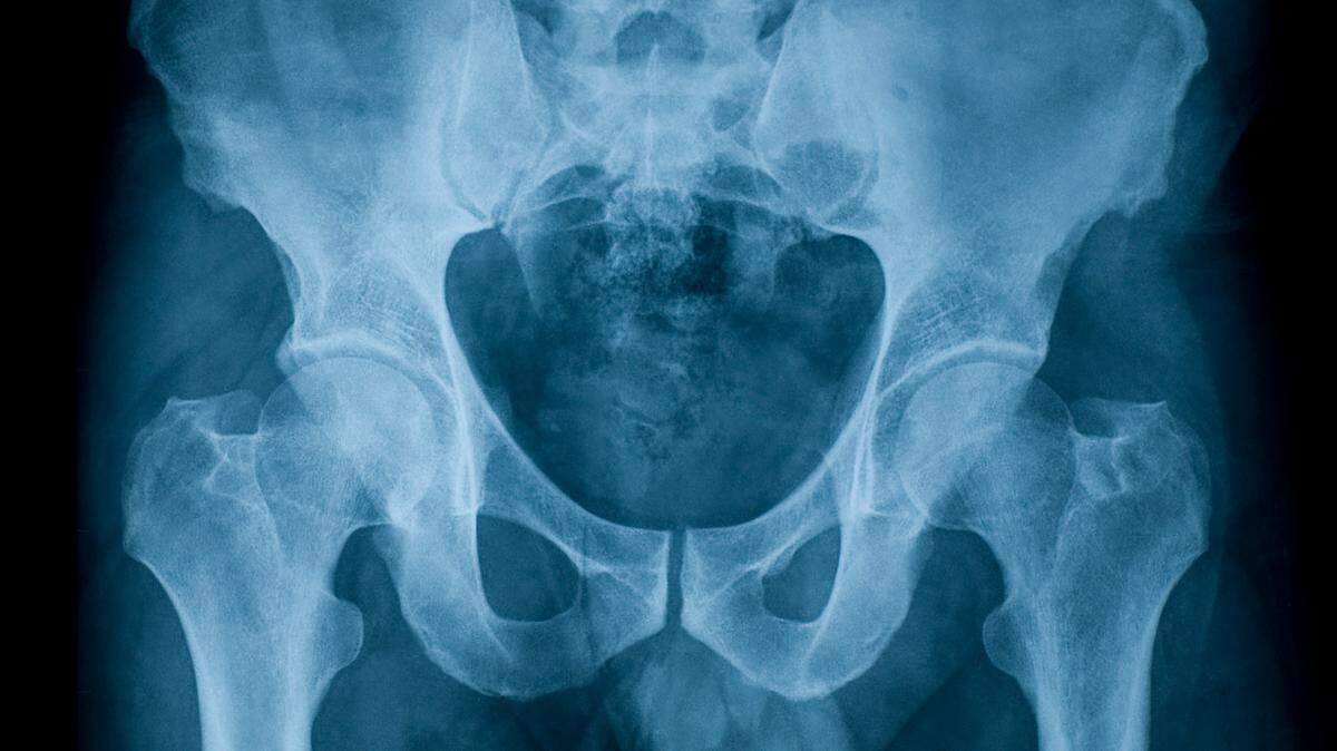 X-ray image of pelvis