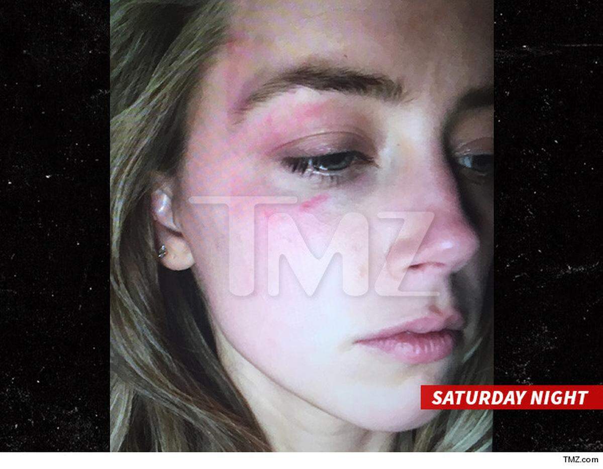 Fotografía obtenida por TMZ que muestras las lesiones en la cara de Amber Heard tras una supuesta agresión de su esposo Johnny Deep.