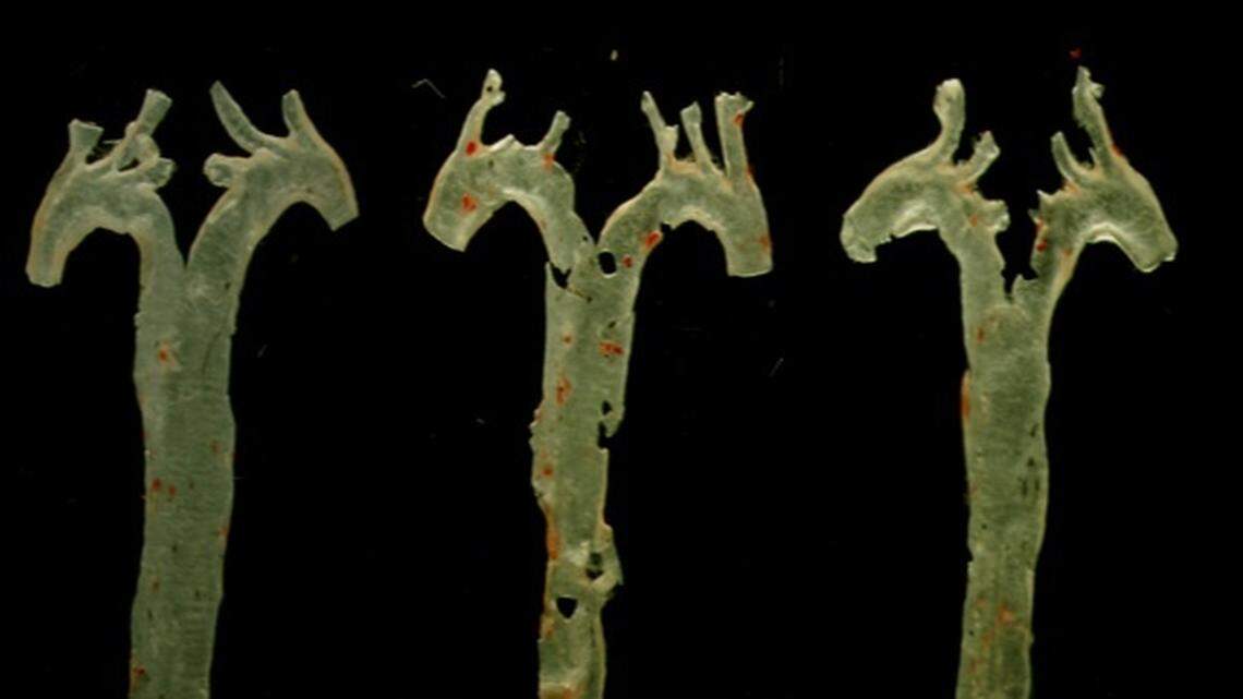 Una molécula generada por bacterias intestinales, nuevo factor clave de la aterosclerosis