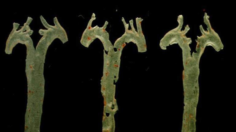Una molécula generada por bacterias intestinales, nuevo factor clave de la aterosclerosis