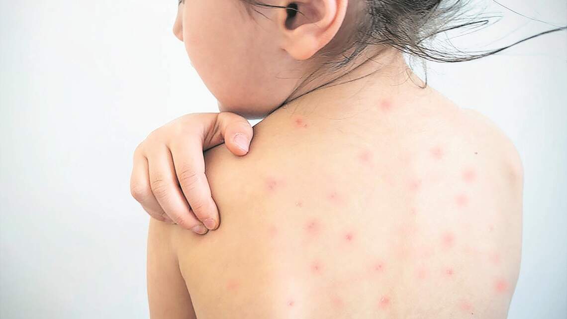 El sarampión supera los 2,500 casos y 38 brotes en EEUU, la mayor cifra en 35 años