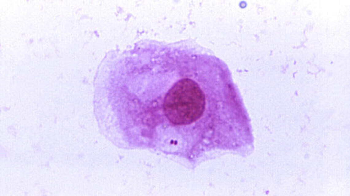 Florida’s meningitis outbreak is much more serious than monkeypox, says state’s top doctor