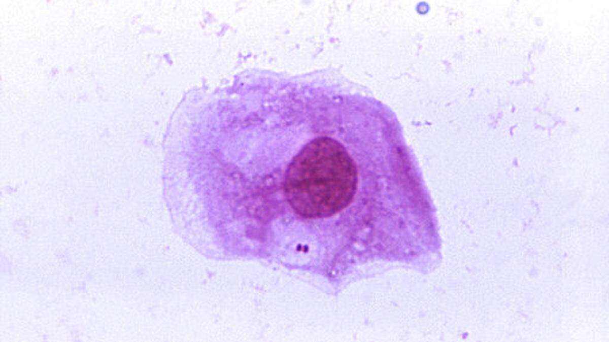 A photomicrograph of the bacteria “Neisseria meningitidis” recovered from the urethra of an asymptomatic male and magnified. The bacteria causes meningococcal disease, a serious disease that is spiking in Florida, state health officials say. JAMES VOLK- CENTERS FOR DISEASE CONTROL AND PREVENTION Public Health Image Library (PHIL)