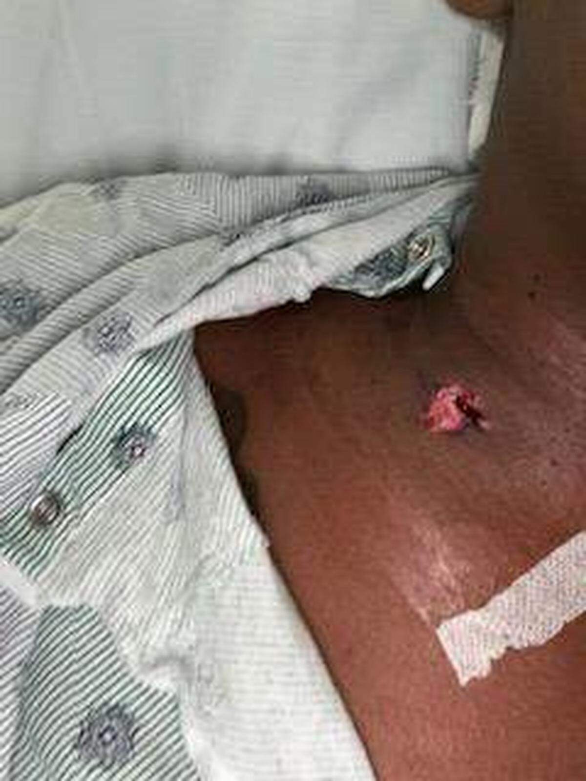 Una foto muestra la herida en el cuello de Esha Dawkins tras recibir un disparo mientras conducía por la Interestatal 95 el lunes 25 de noviembre de 2024.